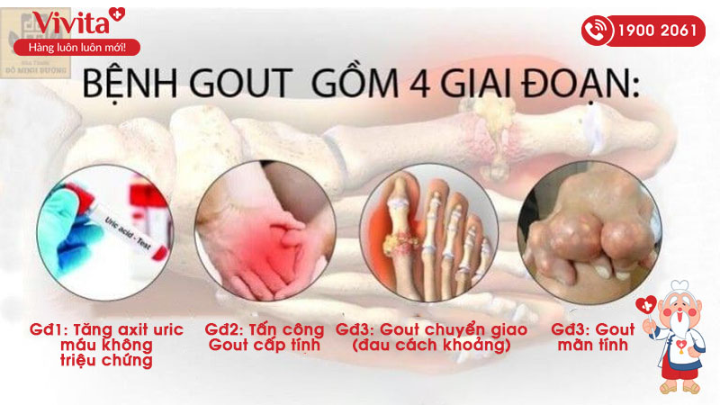 4 giai đoạn của bệnh gout