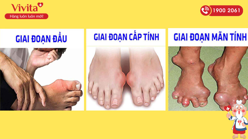 Bệnh gout có 2 loại cấp tính và mãn tính tùy theo tính trạng phát triển của bệnh
