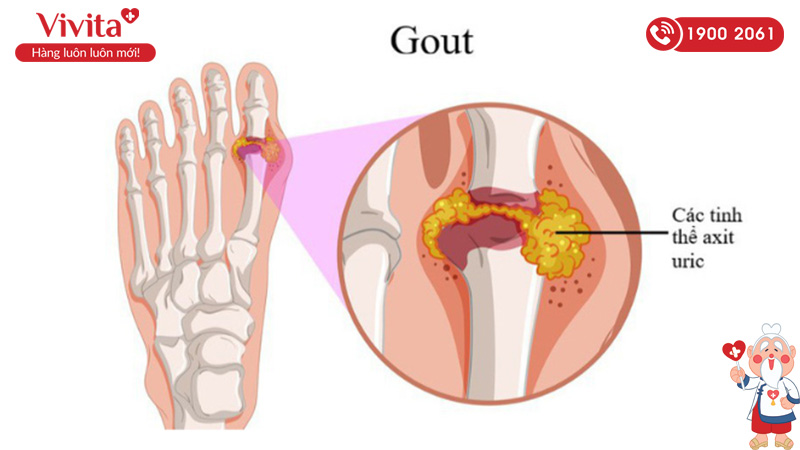 Bệnh Gout khi đã hình thành thì thường phát triển rất nhanh và có thể gây ra những biến chứng vô cùng nguy hiểm ảnh hưởng đến sức khỏe người bệnh
