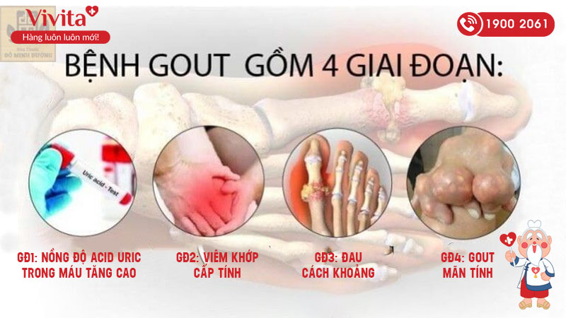 Các giai đoạn của bệnh Gout