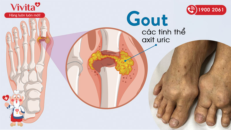 gout là bệnh lý xương khớp khá nguy hiểm