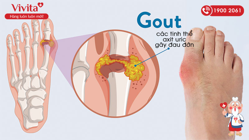 Bệnh Gout xảy ra do sự lắng đọng các axit uric trong khớp
