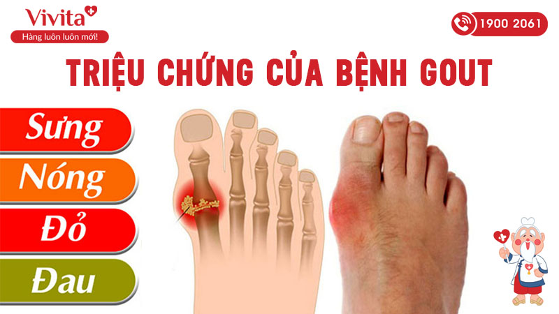 Triệu chứng của bệnh Gout