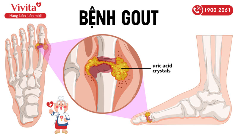 Gout là một dạng viêm khớp phổ biến do rối loạn chuyển hóa purin làm tăng axit uric máu