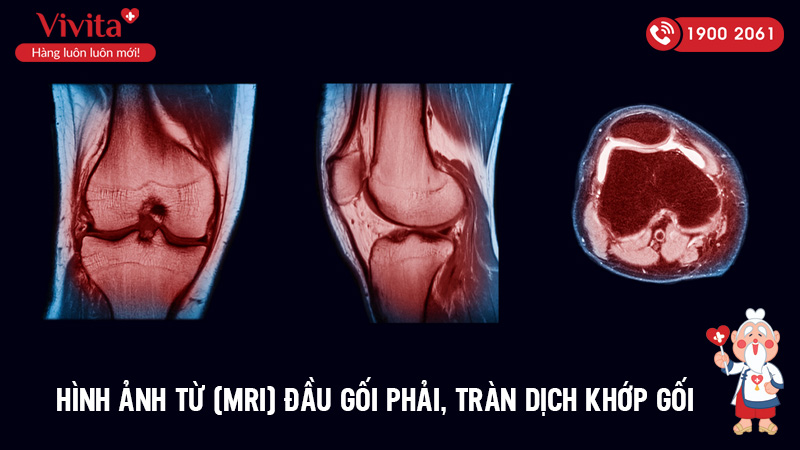Hình ảnh từ (MRI) đầu gối phải, Tràn dịch khớp gối