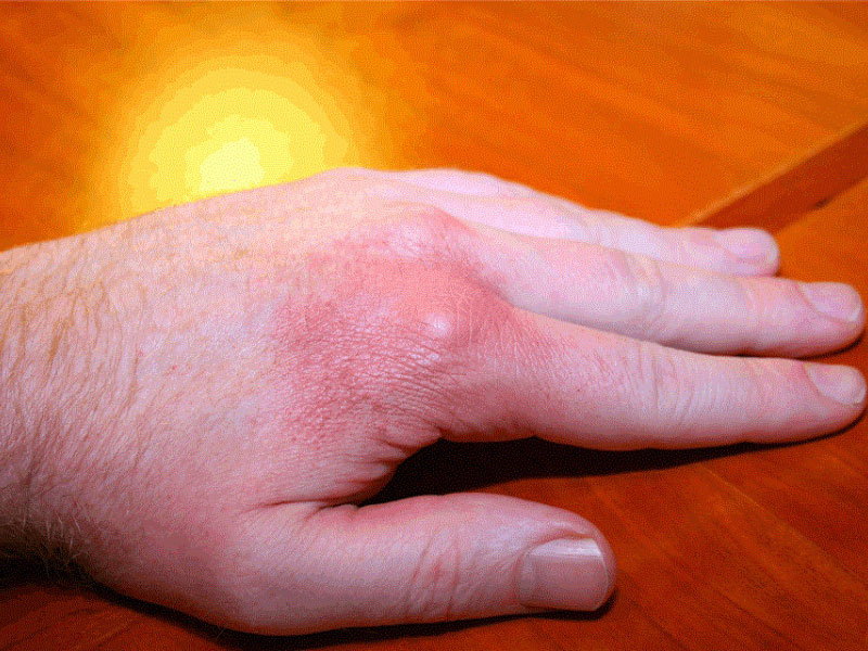 triệu chứng bệnh gout
