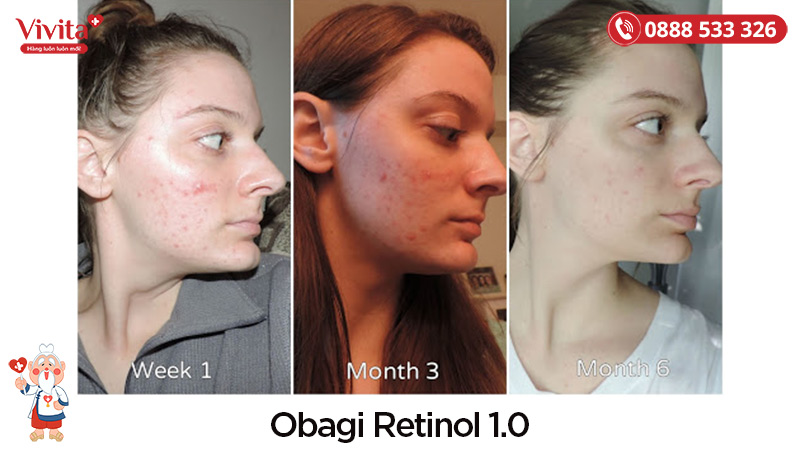 Trước và sau khi sử dụng Obagi Retinol 1.0
