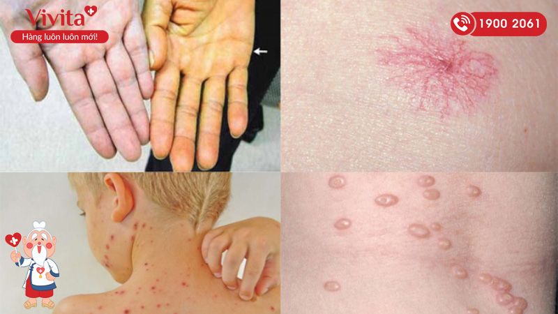 Vàng da và nổi mẩn ngứa là một trong những triệu chứng phổ biến khi men gan tăng cao
