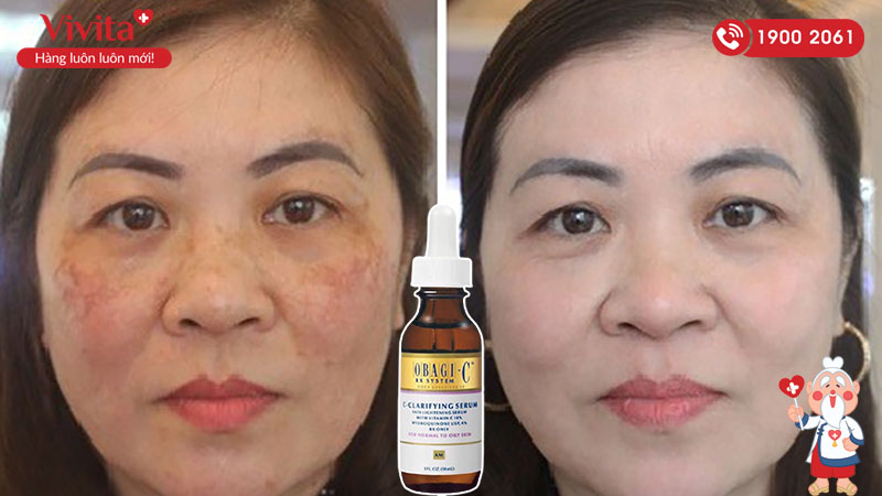 Trước và sau khi sử dụng Clarifying Serum for Oily Skin
