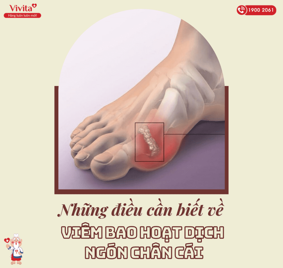 Tổng hợp các thông tin quan trọng về viêm bao hoạt dịch ngón chân cái.