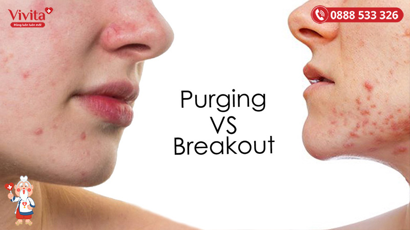Điểm khác biệt giữa purging và breakout là breakout bị mụn ở những vùng bạn chưa từng bị và mụn kéo dài liên tục mà không có dấu hiệu giảm. 