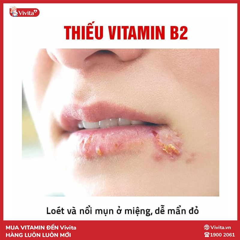 dấu hiệu thiếu vitamin b2 là lở miệng