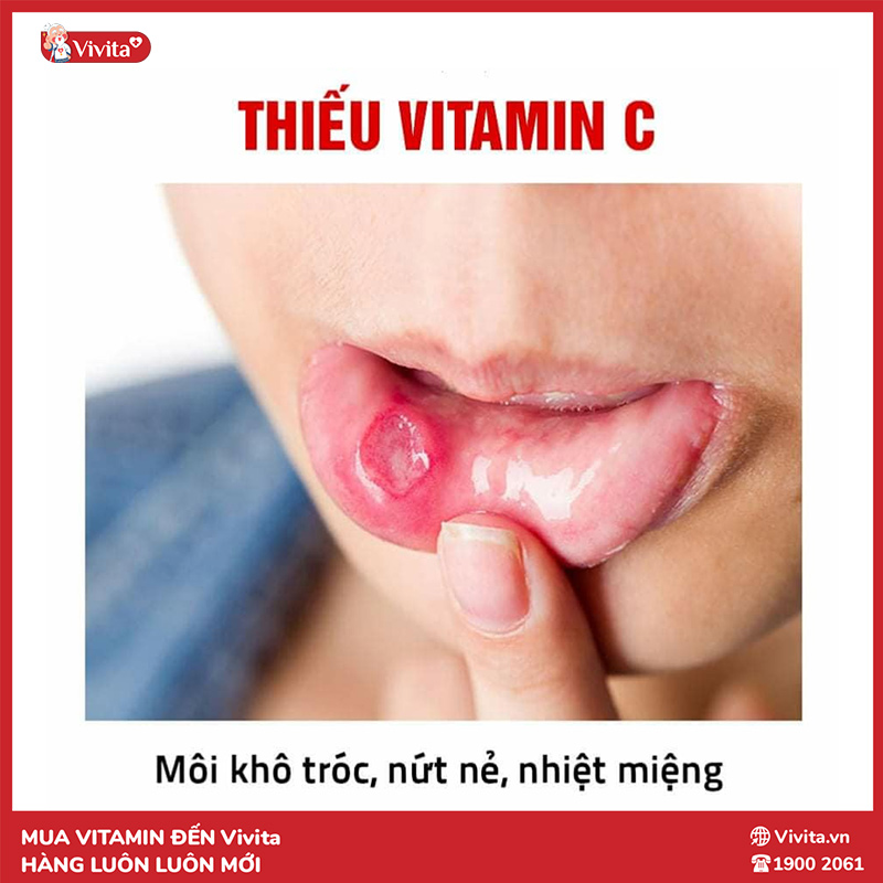 dấu hiệu thiếu vitamin c là lở miệng