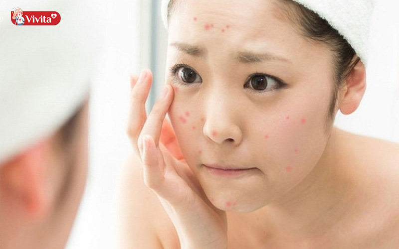 Tác dụng của vitamin C cho da mặt là hỗ trợ giảm mụn, thâm mụn