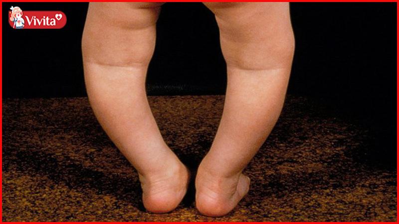 biến dạng xương dài ở trẻ thiếu hụt vitamin d
