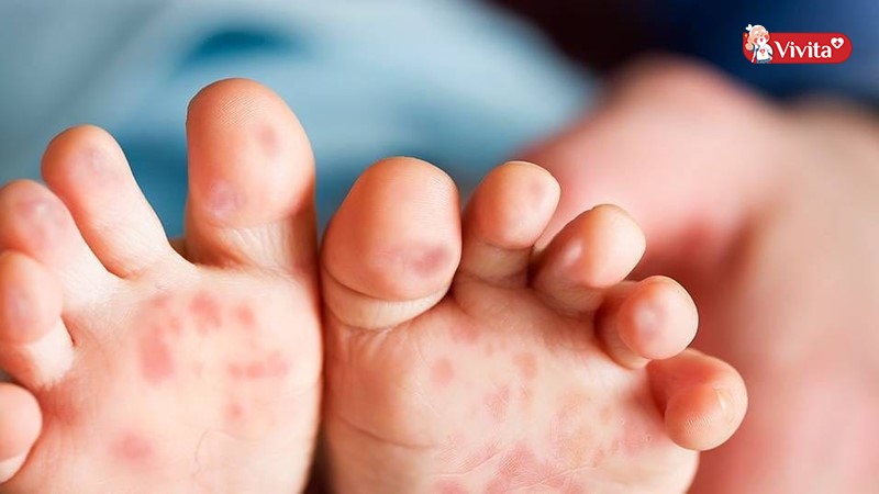 8 Loại lá tắm cho trẻ tay chân miệng giúp nhanh khỏi