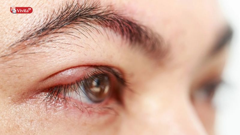 Vệ sinh mắt bị lẹo đúng cách ngừa nhiễm trùng