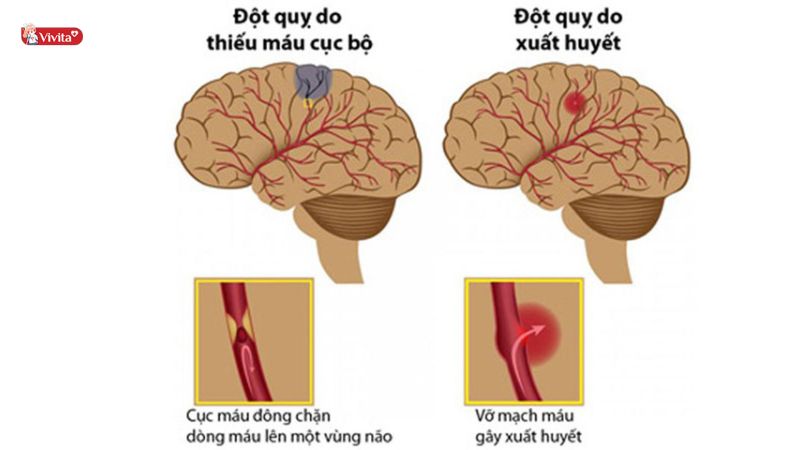 các dạng đột quỵ chính