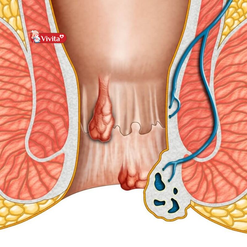 Bệnh trĩ ngoại hình thành như thế nào?