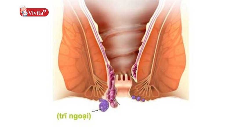 Bị Trĩ Nhẹ Có Tự Khỏi Được Không?