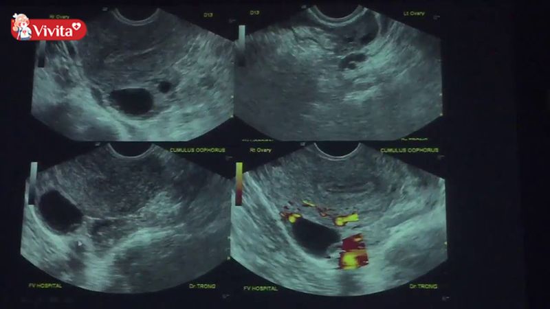 Siêu âm cũng là cách xác định ngày rụng trứng thường gặp
