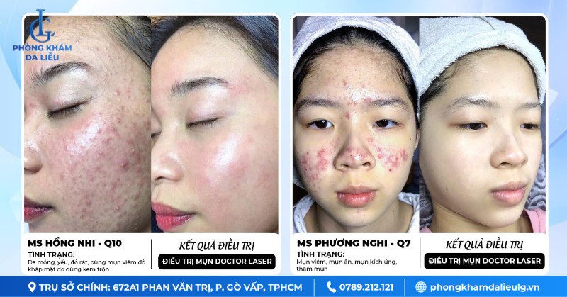 Doctor Laser là công nghệ trị mụn độc quyền tại Phòng Khám Da liễu LG