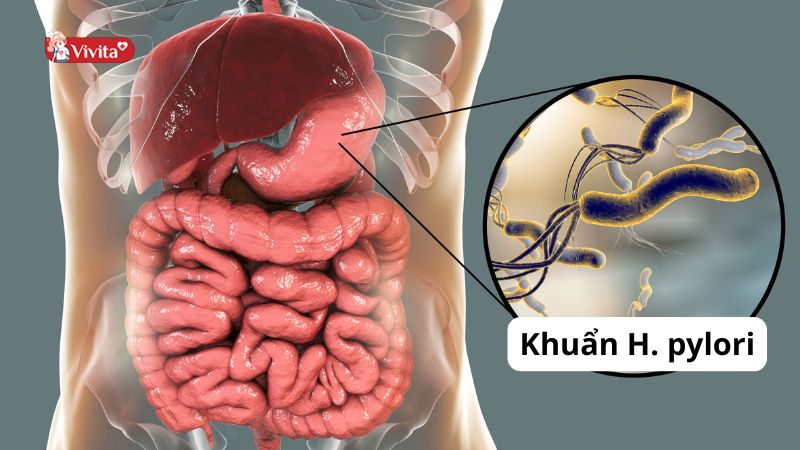 Dạ dày nhiễm vi khuẩn H. pylori