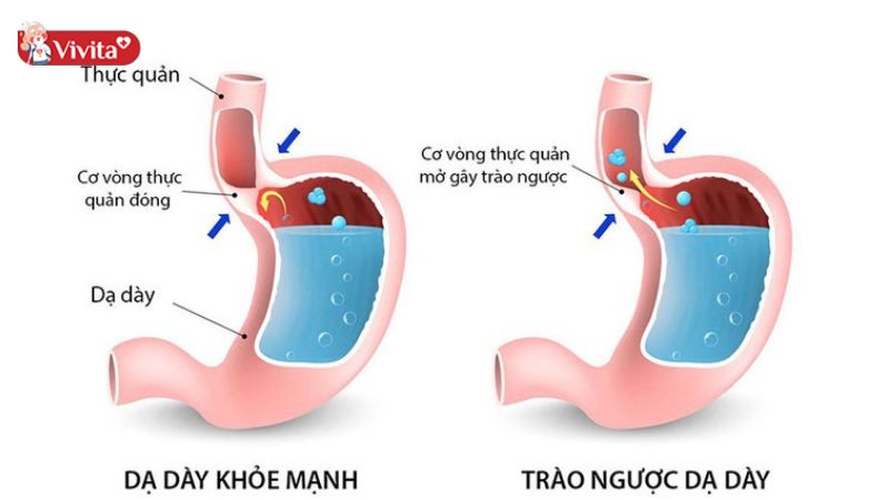 Sự khác biệt giữa dạ dày khoẻ mạnh và trào ngược dạ dày