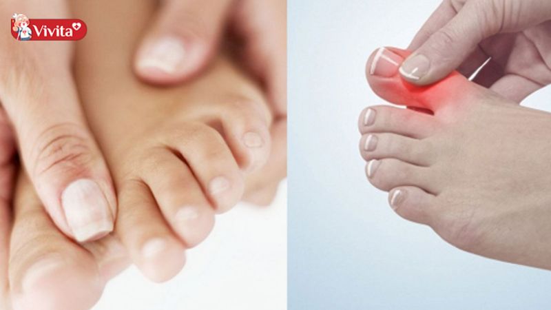 Ngón chân cái bị viêm khớp có biểu hiện rõ ràng