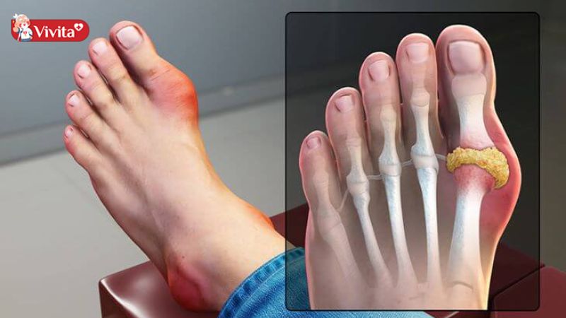 Viêm khớp ngón chân cái do nhiều nguyên nhân gây ra