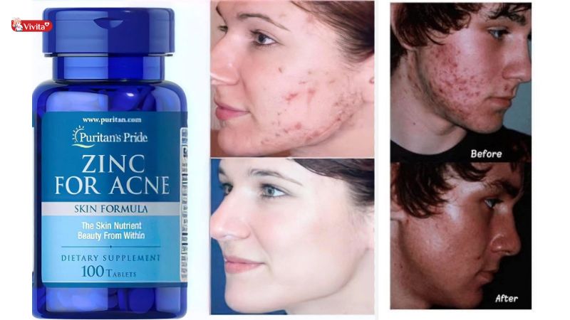 Viên kẽm Zinc For Acne có thật sự hiệu quả không?