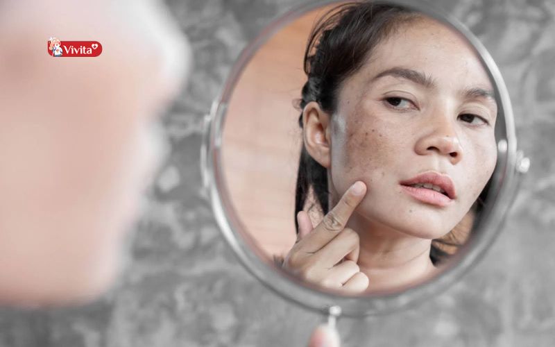 Vitamin C giúp giảm thâm nám