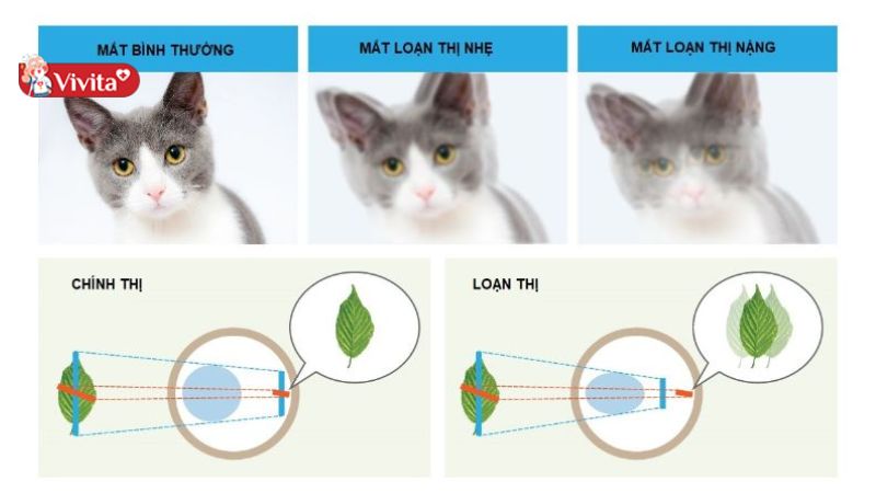 loạn thị có mổ được không