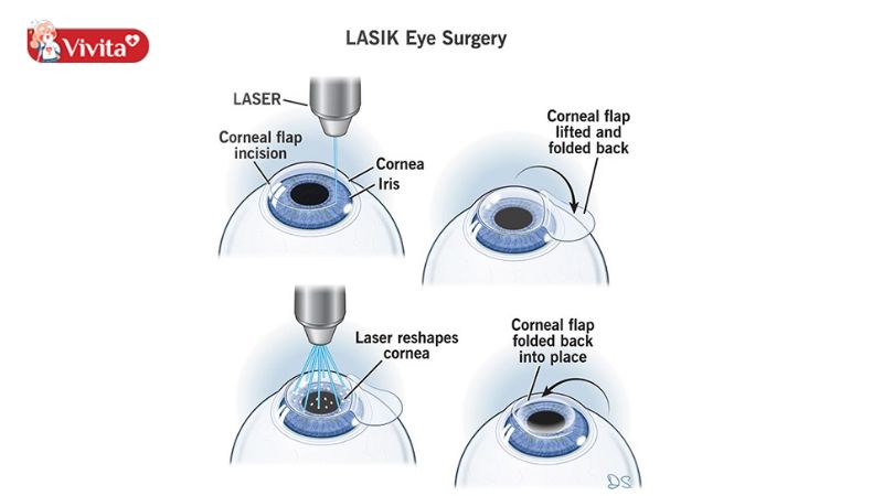 loạn thị có mổ được không