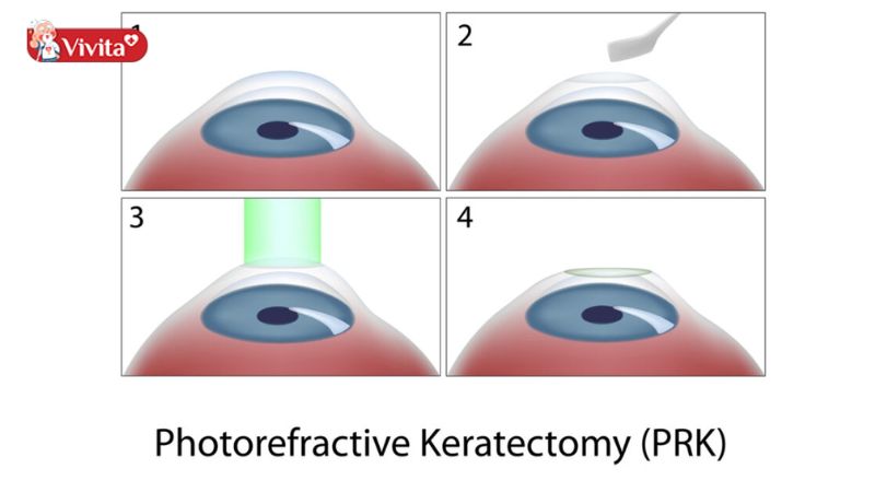 Phương pháp mổ mắt PRK
