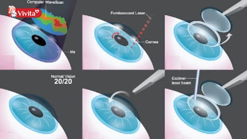 Tuỳ vào tình trạng loạn thị mà bác sĩ sẽ tư vấn việc phẫu thuật phù hợp