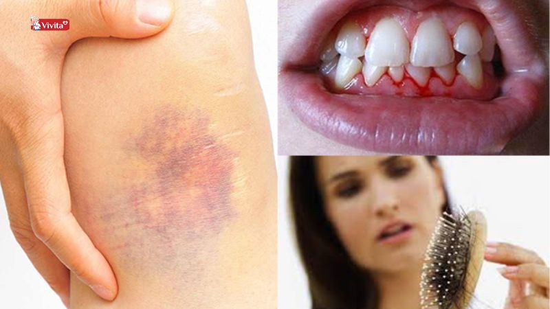 Bệnh Scorbut do thiếu vitamin c kéo dài