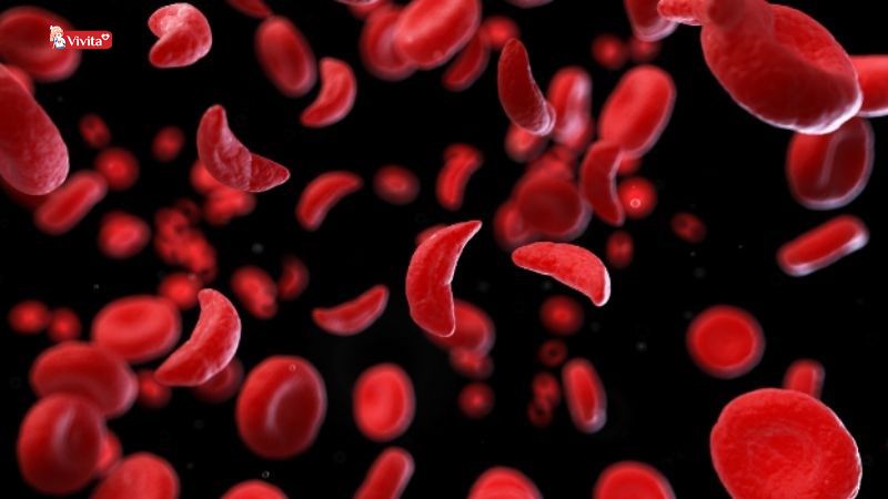 thiếu máu do thiếu sắt 