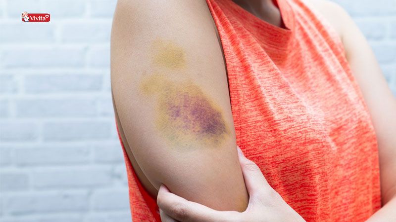thiếu vitamin c gây ra bầm tím