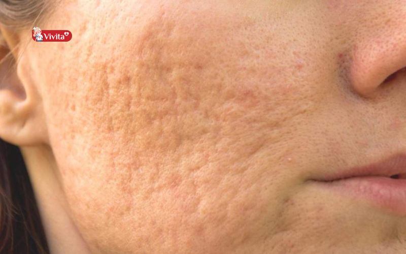 Các loại sẹo rỗ phổ biến