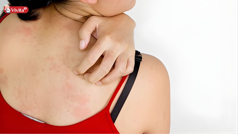 Cải thiện tình trạng mẩn ngứa trên da