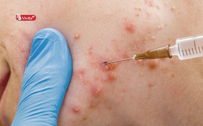 Phương pháp bóc tách đáy sẹo