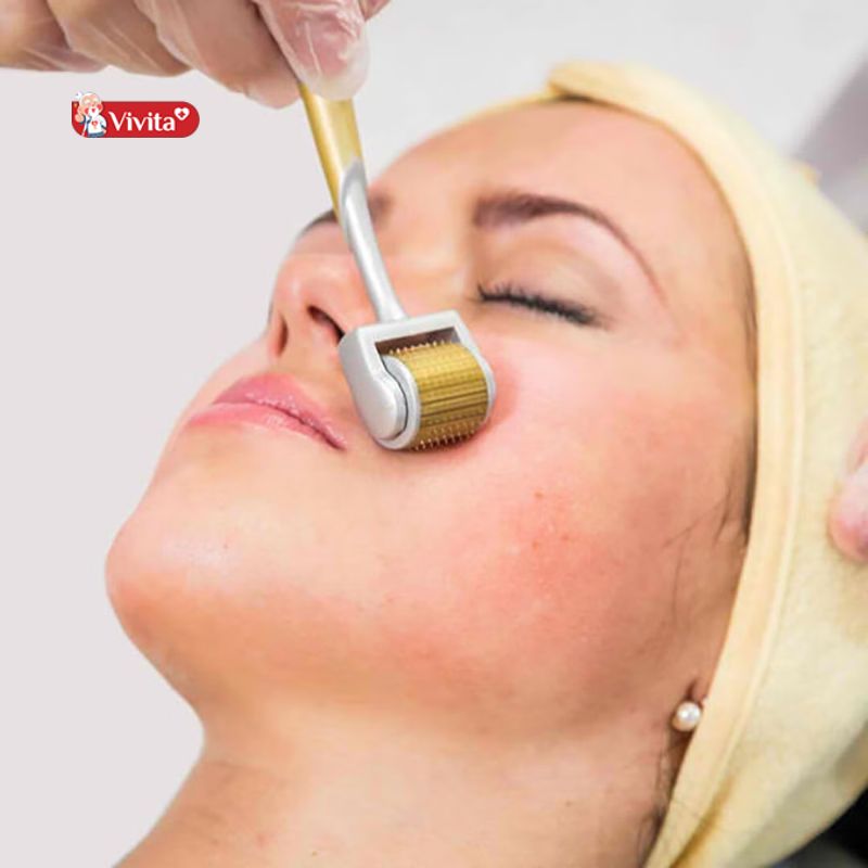 Phương pháp lăn kim/phi kim trị sẹo