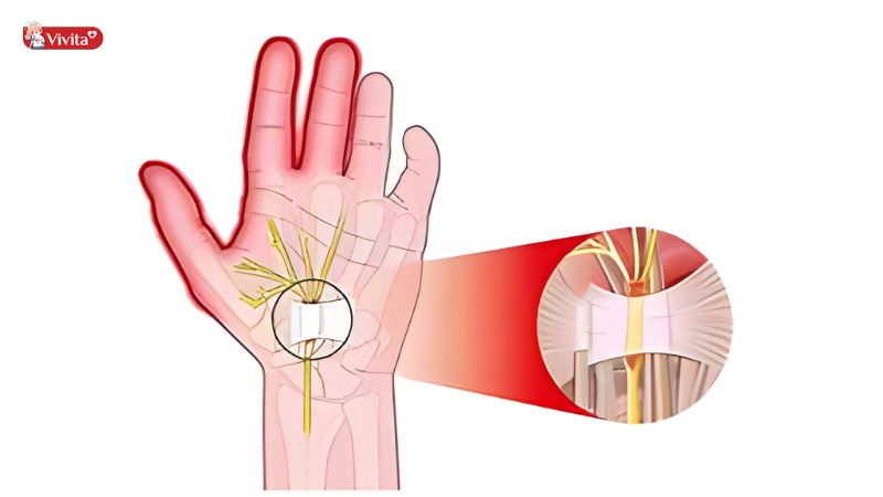 Chấn thương và chèn ép dây thần kinh