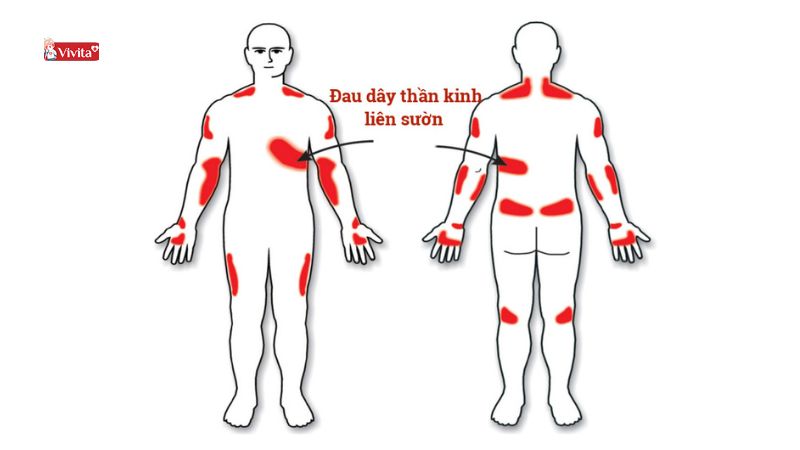 triệu chứng đau dây thần kinh liên sườn