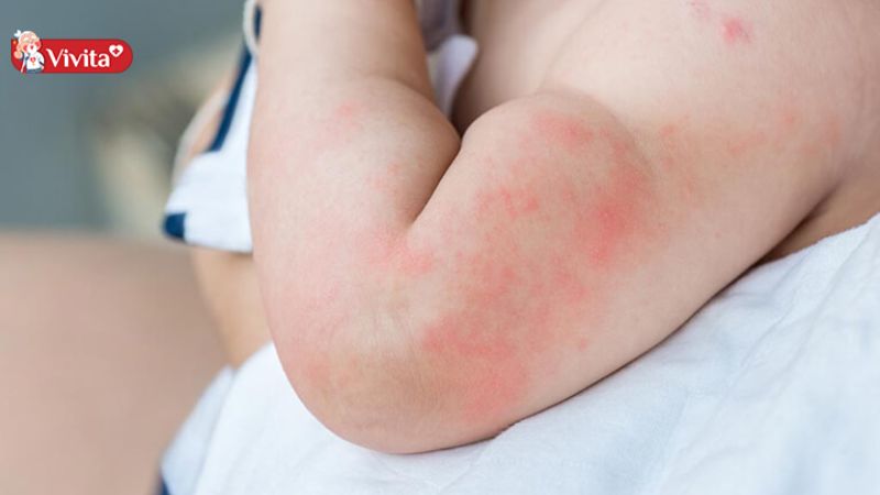 Ba mẹ nên quan sát các triệu chứng bất thường ở trẻ để xử lý kịp thời