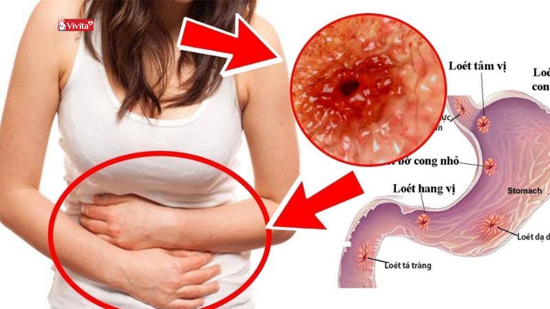 đau dạ dày