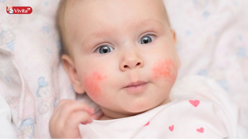 Dị ứng thức ăn có nguy hiểm không? 