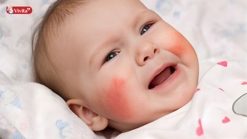 Dị ứng thức ăn ở trẻ là gì?