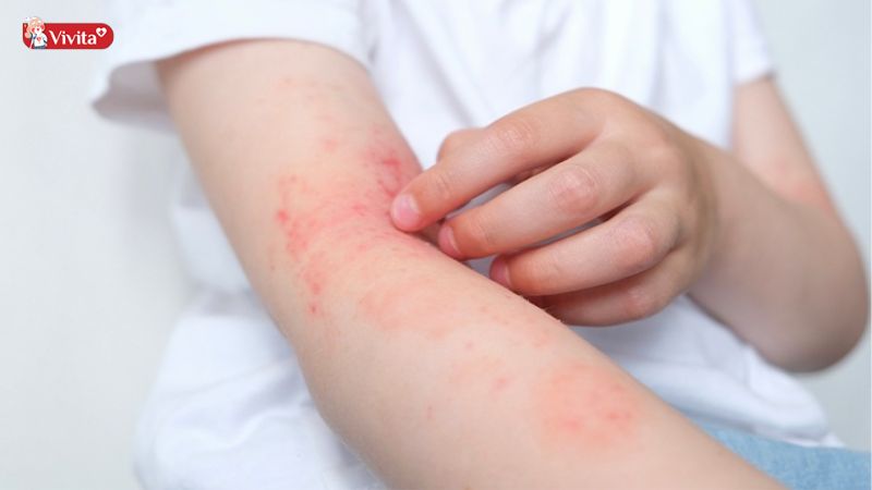 Nguyên nhân khiến trẻ bị dị ứng thức ăn
